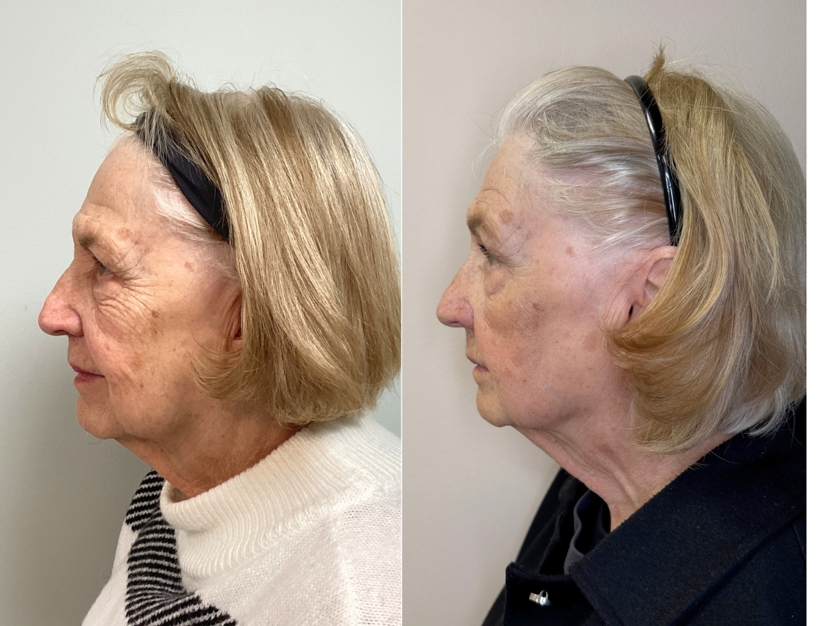 Side-by-side comparison of an elderly woman before and after a facelift. In both images, she has blonde hair held back with a black headband and is wearing a sweater or jacket.