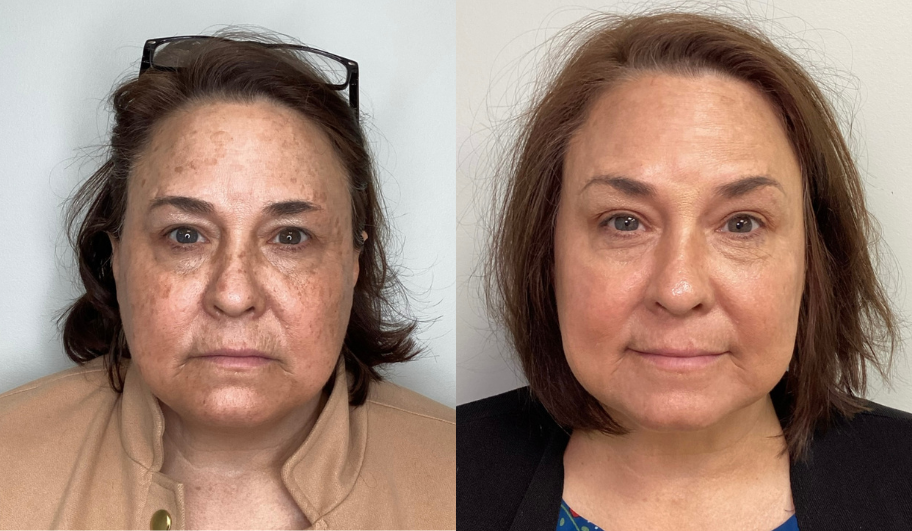 Side-by-side comparison of a woman's face before and after skincare treatment, showing significant reduction in pigmentation, freckles, and uneven skin tone, with improvements in skin texture and appearance.