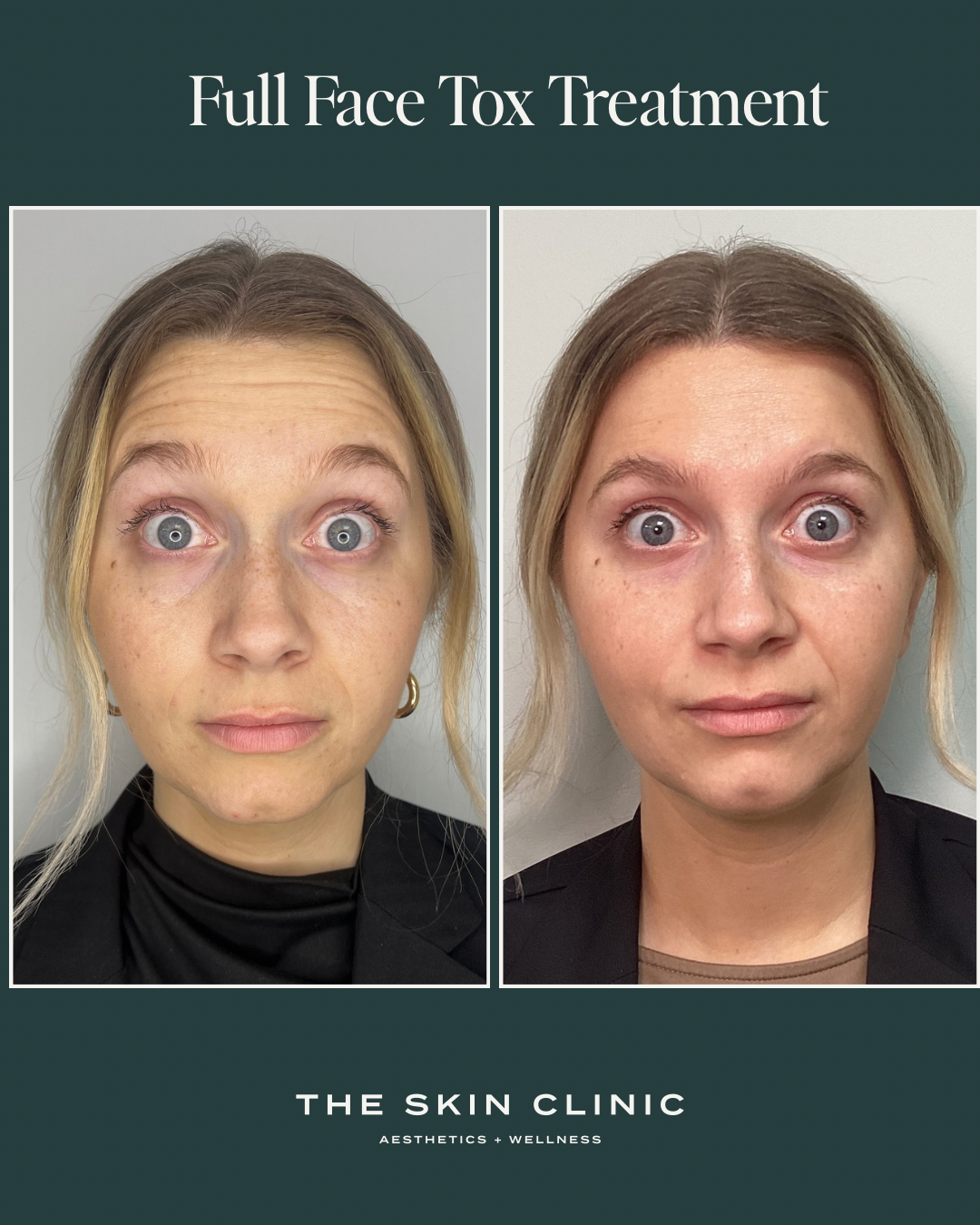 Botox treatment