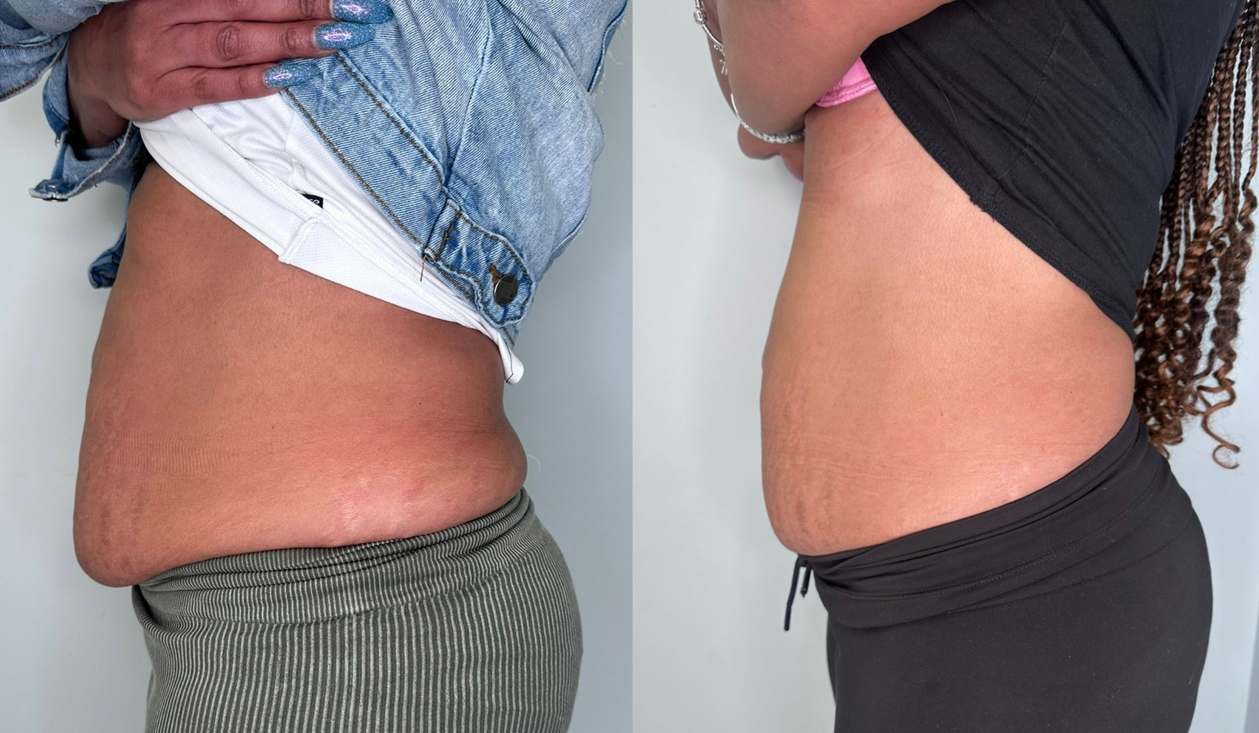 Side-by-side comparison of a person's waist before and after weight loss or body transformation, showing a reduction in abdominal size.