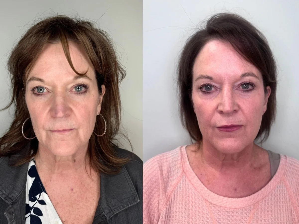 EMFACE NON SURGICAL FACE LIFT, MANNKATO