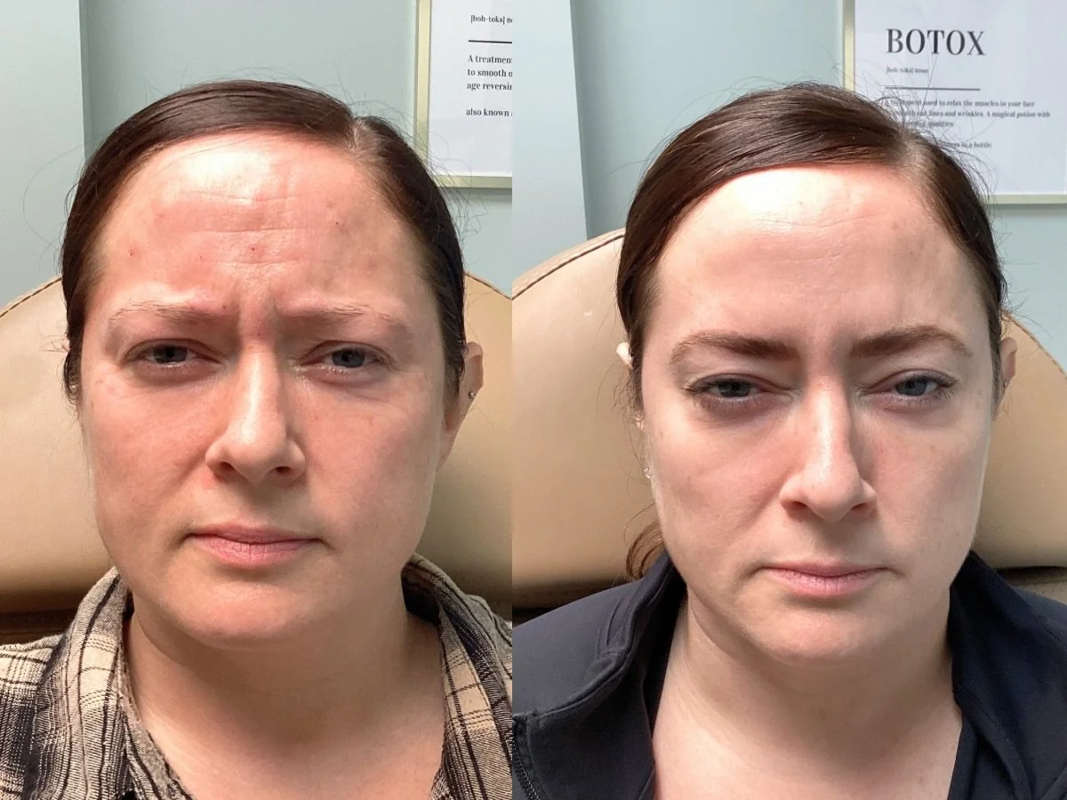 Botox treatment