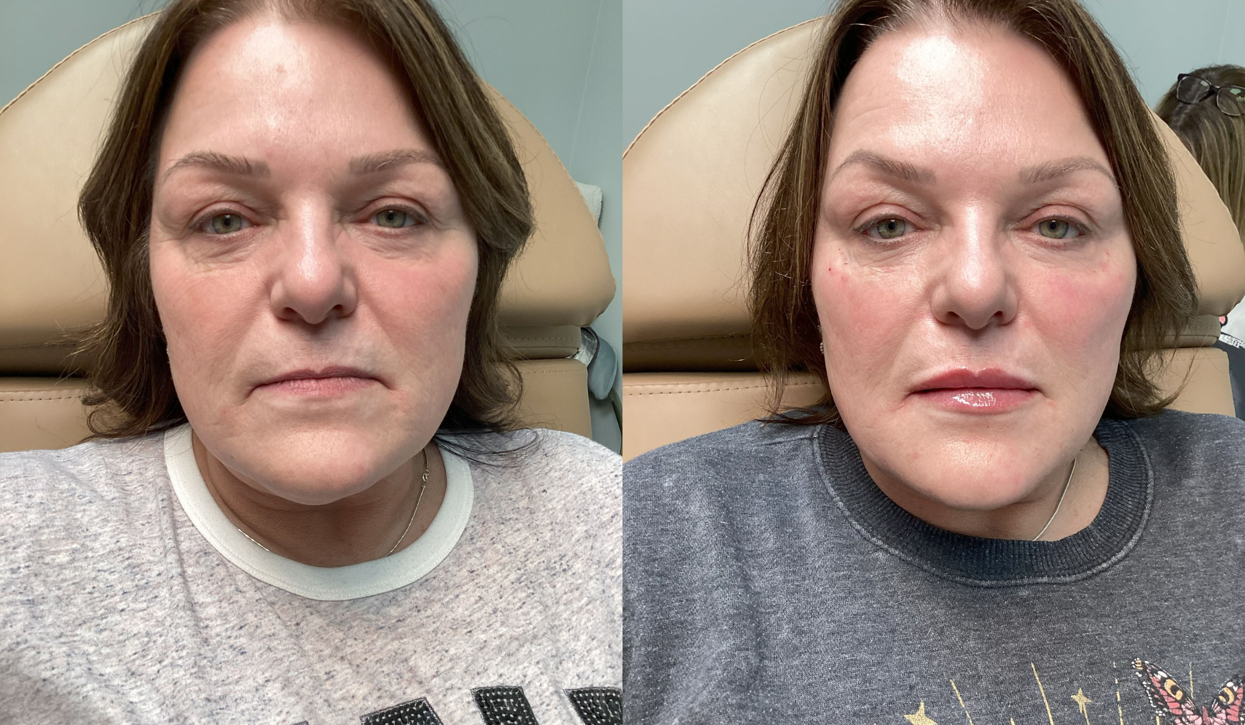 Side-by-side comparison of a woman with short brown hair showing before and after her facial treatment, wearing a light gray sweatshirt in the first image and a dark gray sweatshirt in the second image, with a beige chair in the background.