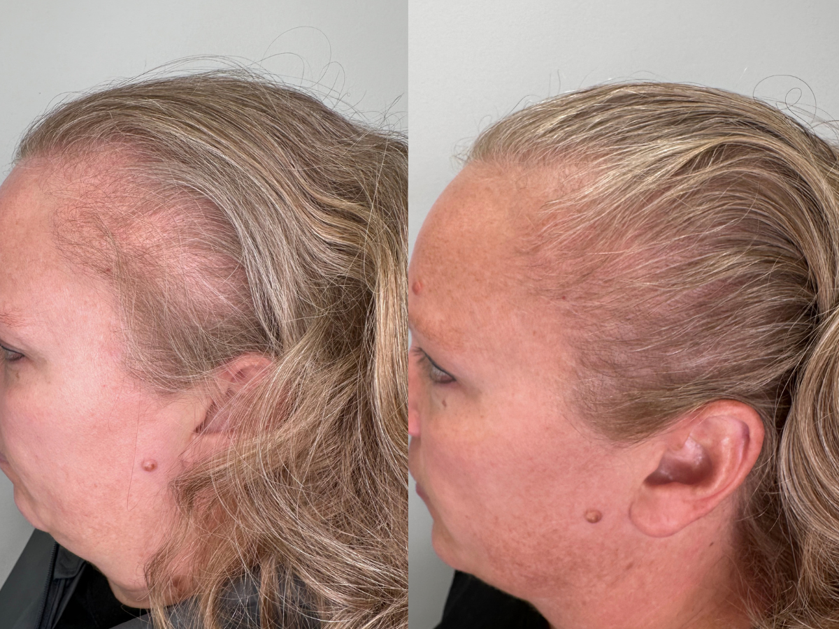 Before and after images of a woman's scalp showing hair restoration results, with improved hair density and coverage on the right.
