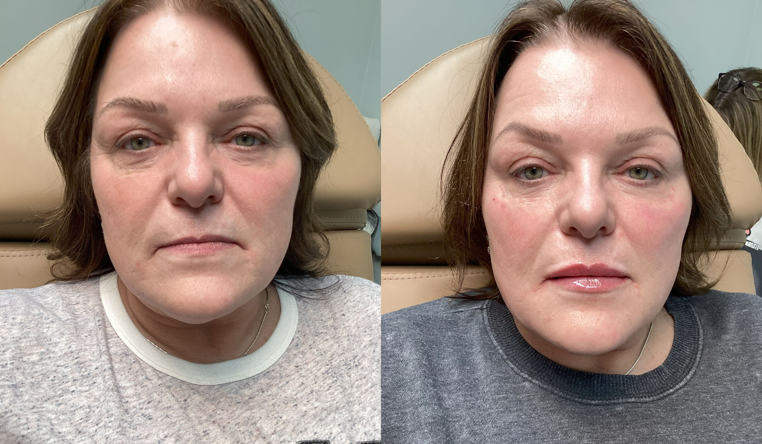 Side-by-side comparison of a woman before and after cosmetic treatment, showing improvements in facial appearance including smoother skin and reduced wrinkles.