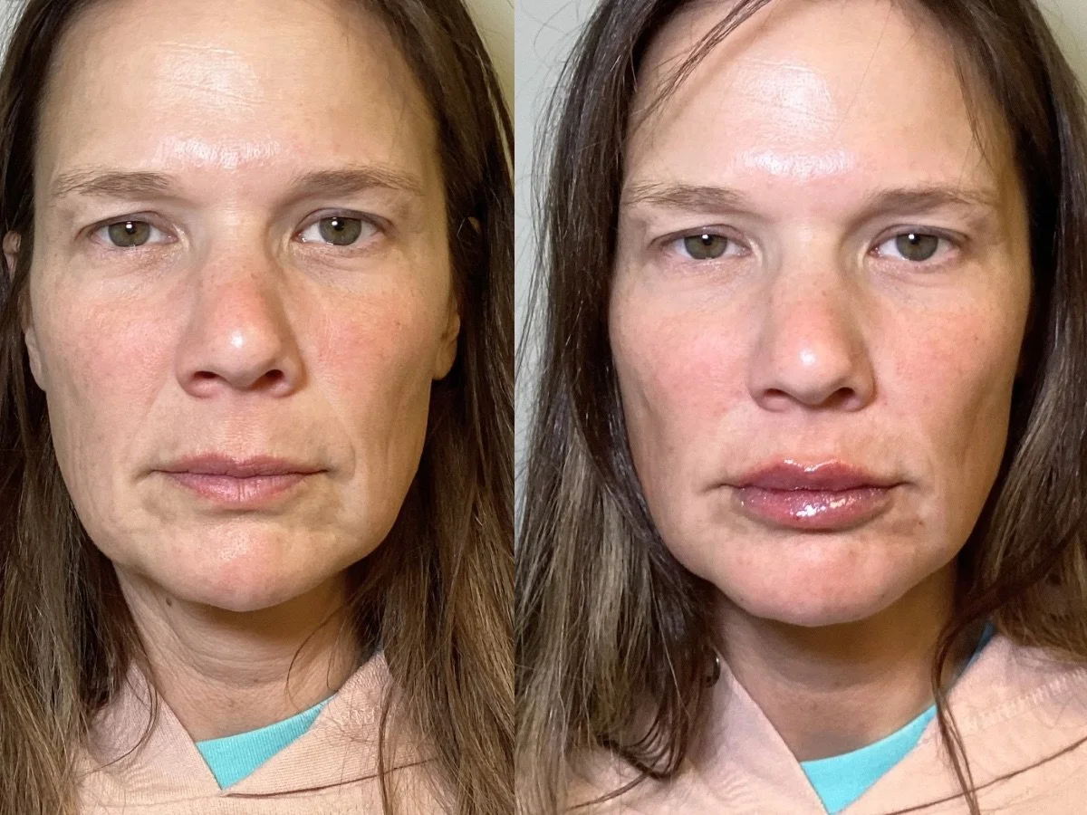 Lip Filler The Skin  CLinic, Mankato, M