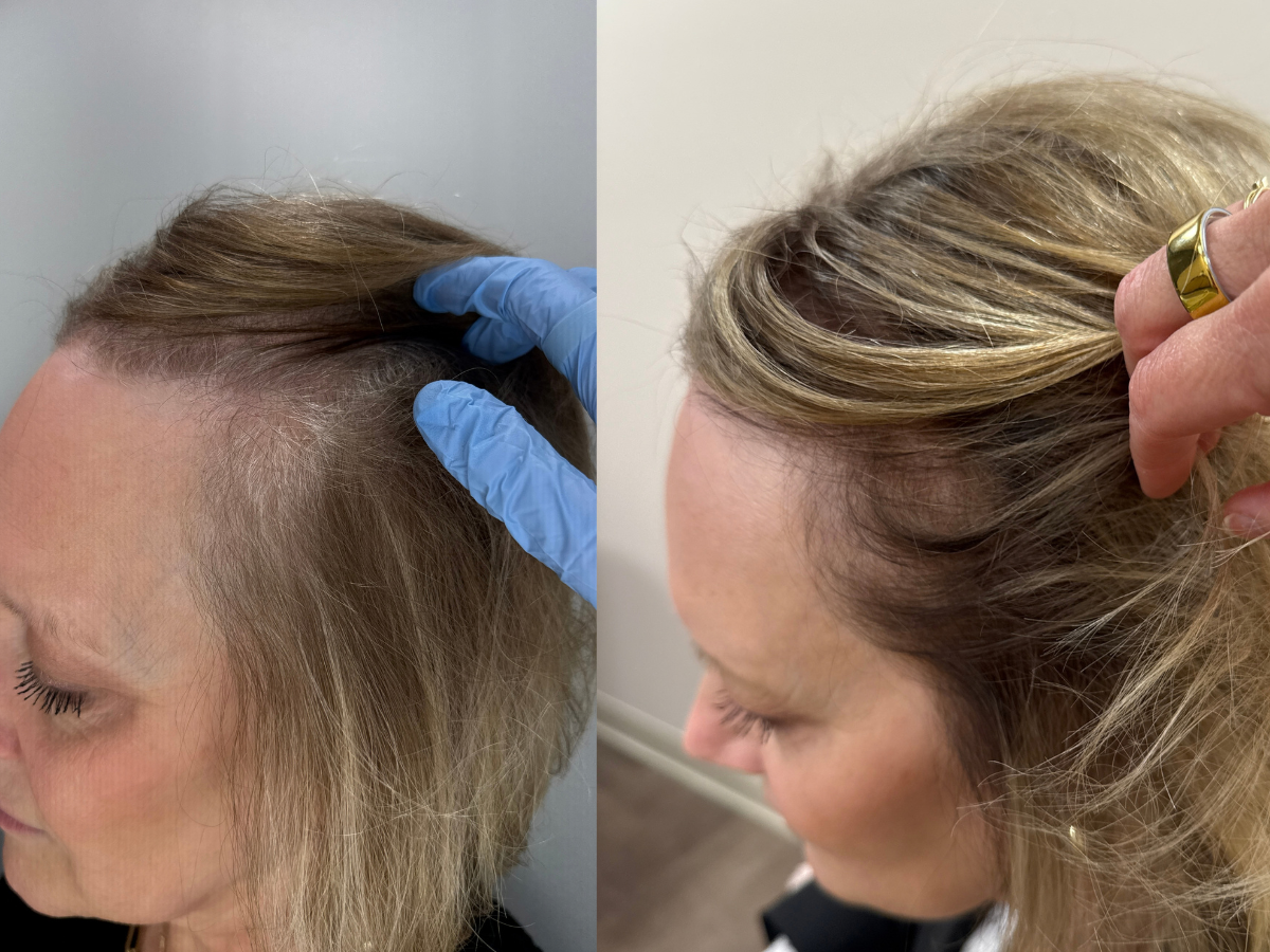 Comparison of a woman's scalp showing hair loss on the left and hair regrowth on the right.
