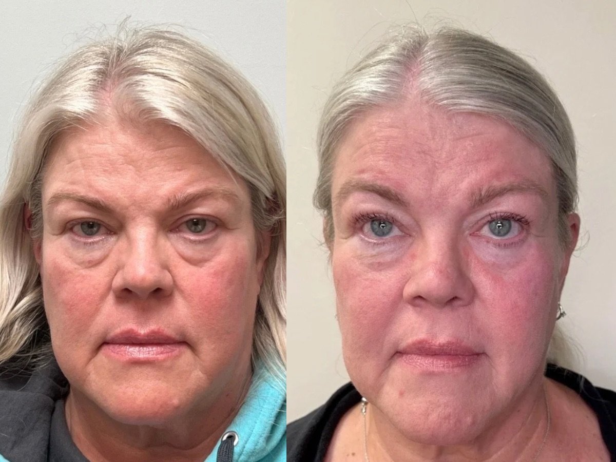 Emface Non Surgical Facelift, the skin clinic, Mankato