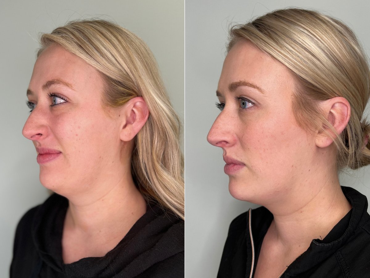 Side-by-side comparison of two women, showing before and after images of a cosmetic procedure, with clear skin and well-defined facial features, wearing black clothing, set against a plain background.