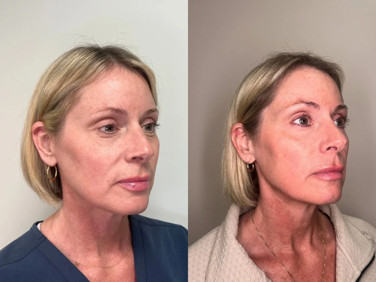 Emface Non Surgical Facelift, the skin clinic, Mankato