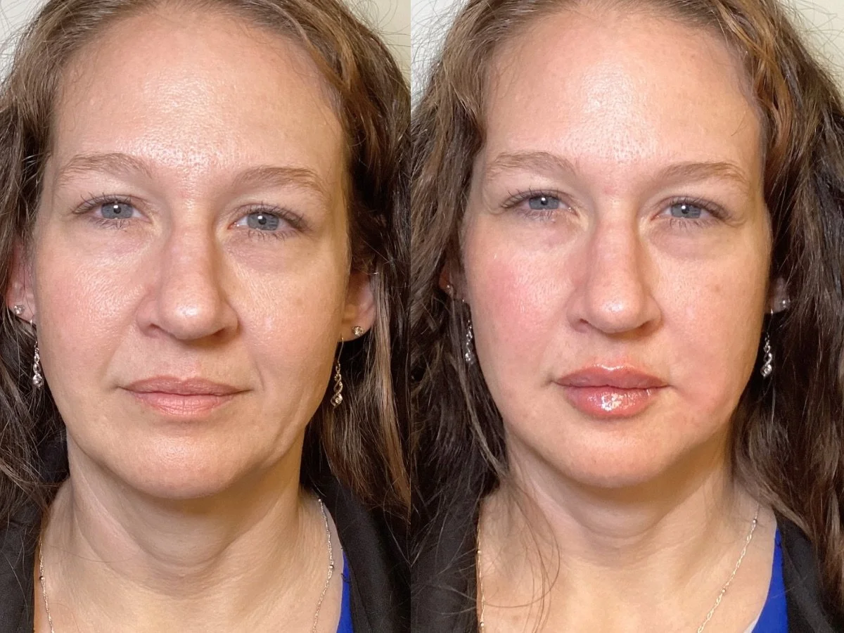 Botox before and after first treatment 