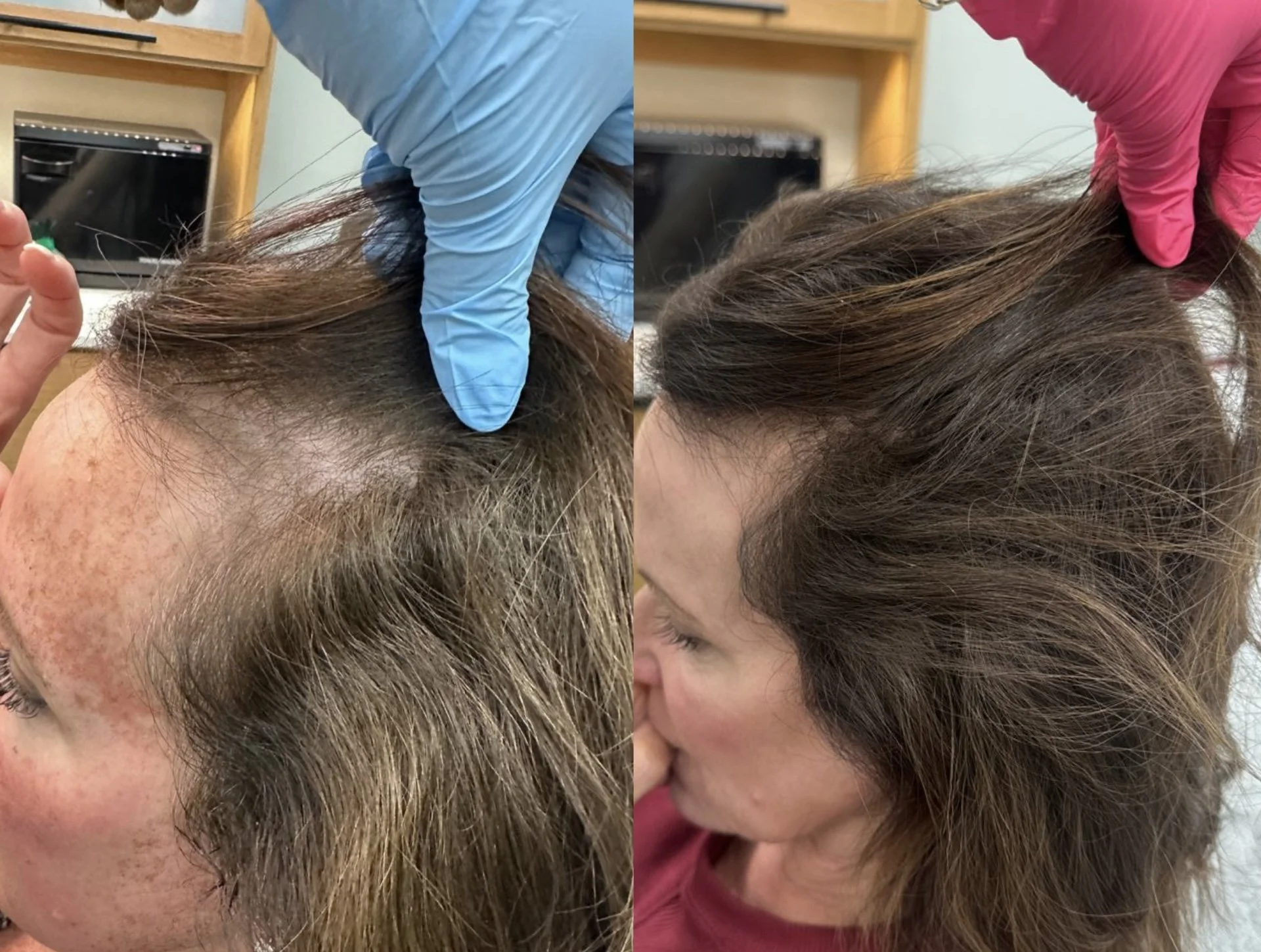 Side-by-side before and after images showing a person with thinning hair on the top of their head, with visible hair loss in the first image and fuller hair in the second image after treatment.