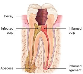Root Canal Therapy