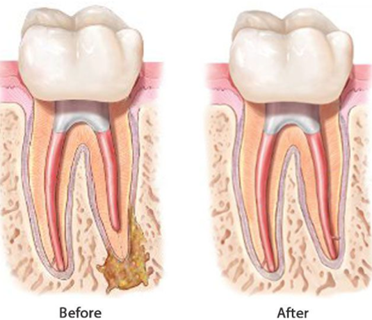 Root Canal Retreatment