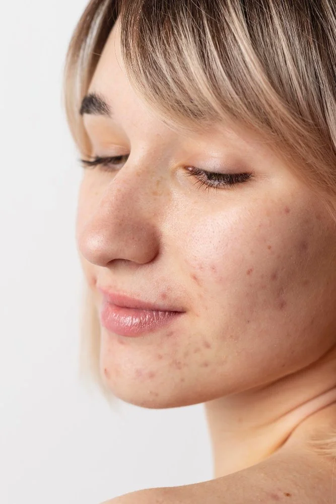 How Long Does It Really Take for Acne Scars to Fade?