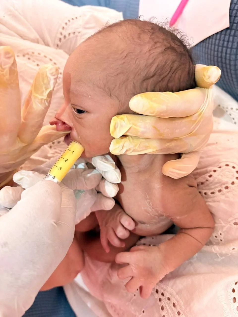 How many hands does it take to feed a newborn? In Emmanuel&rsquo;s case, 4! 🤍

Emmanuel was born with clefts affecting his upper lip, gum ridge, and hard palate, making something as basic as feeding a real challenge.

Normally, a baby seals their li