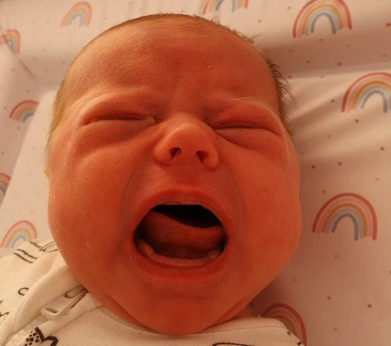 What Are Tethered Oral Ties (TOTs)?