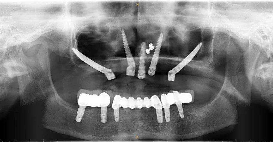Zygoma, nasal and incisive