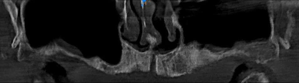Pradeep Zygoma Pre op CBCT.jpg