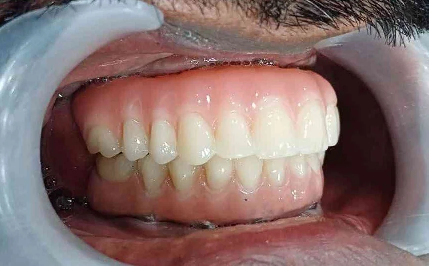 Final Hybrid Denture- Pradeep.jpeg