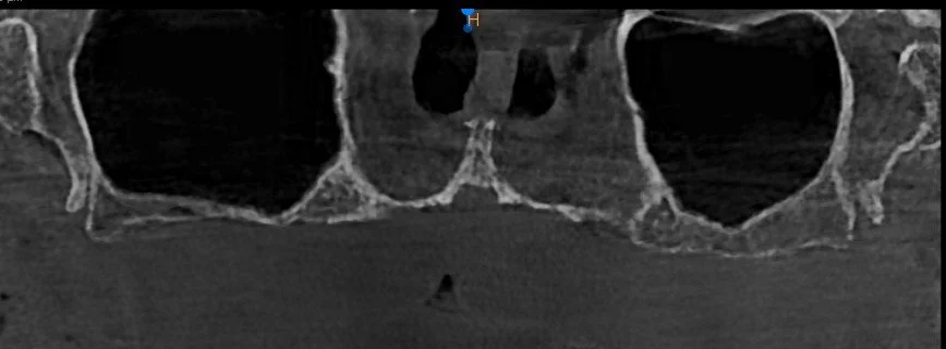 Rukmini Pre op CBCT.jpg