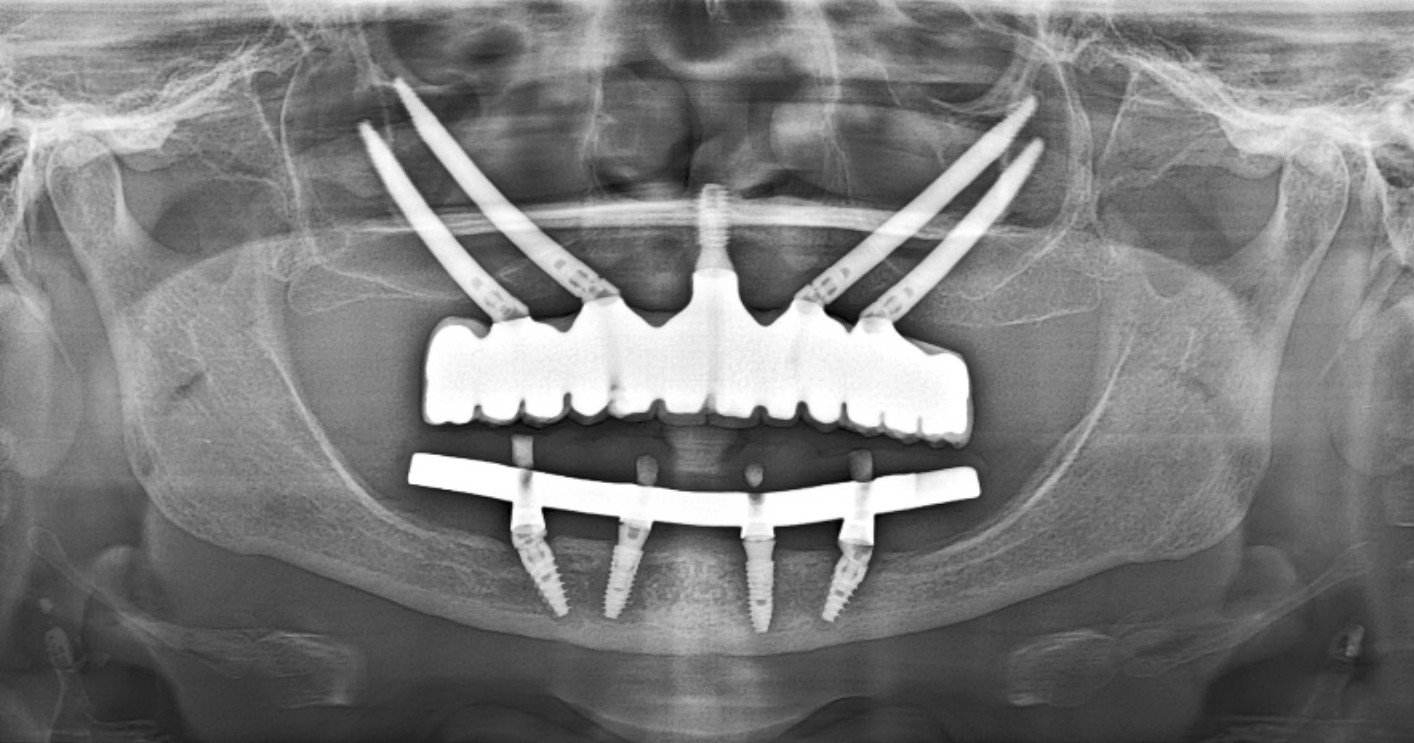 Quad Zygoma.jpg