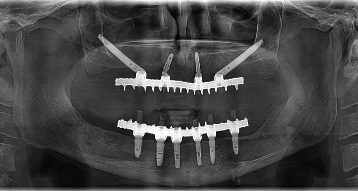 Bilateral Zygoma