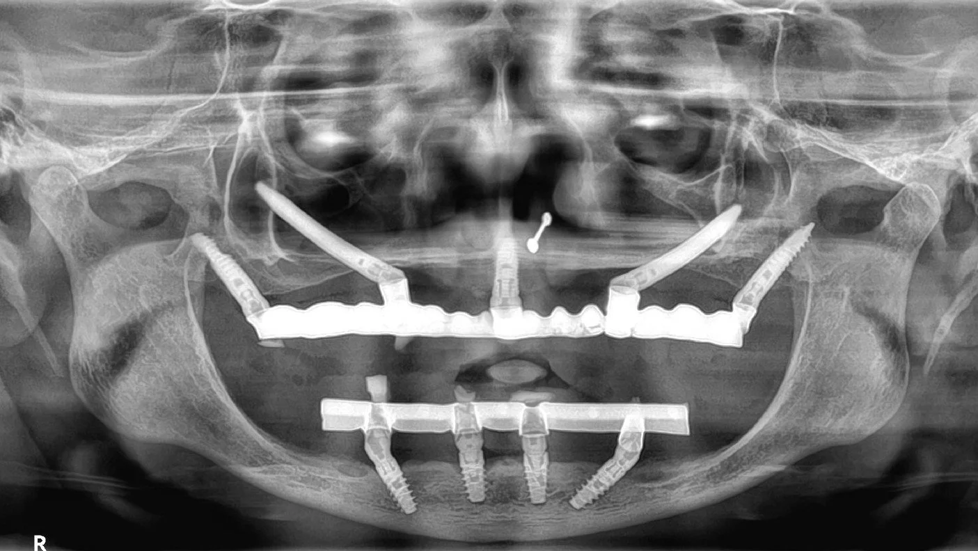 Bilateral Pterygoid, zygoma, incisive