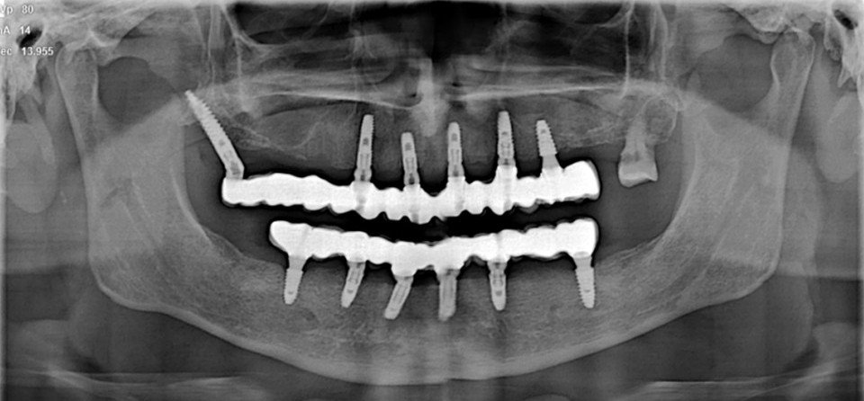 Salvage Treatment in failed implant