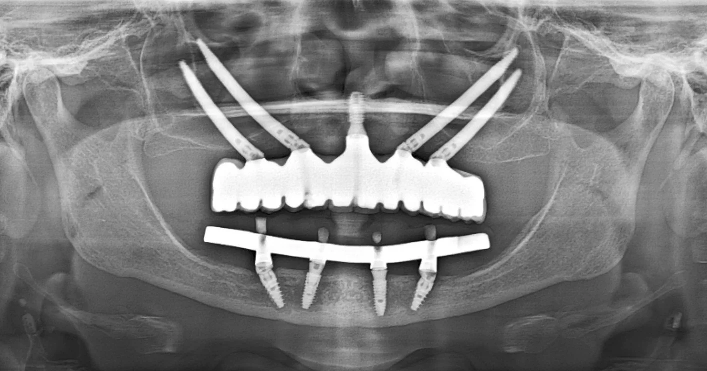 Quad Zygoma