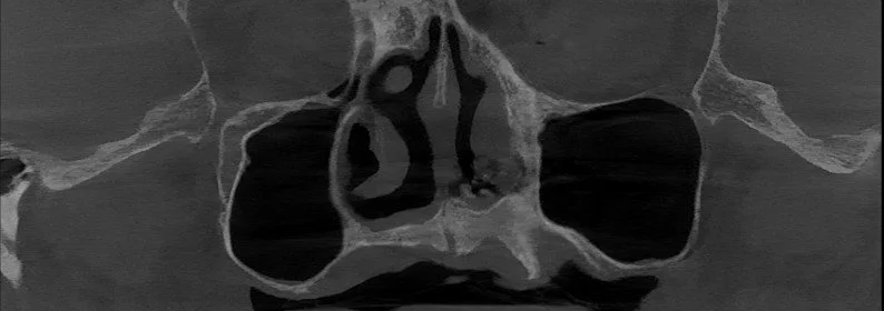 Nasal, zygoma incisive.jpg