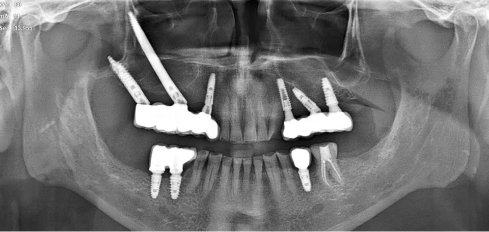 Salvage Treatment 2 in failed implant