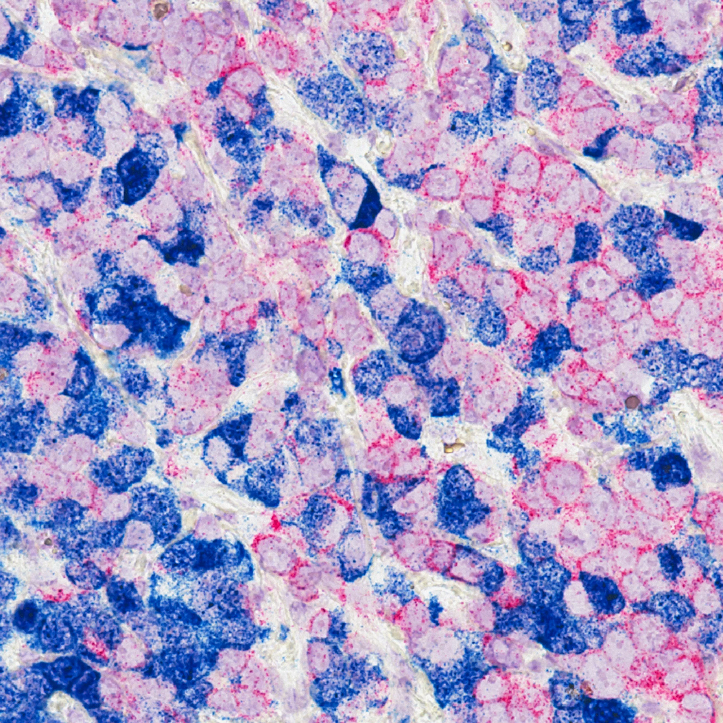 Anal Cancer – What Is It, Am I at Risk and Should I Be Screened?