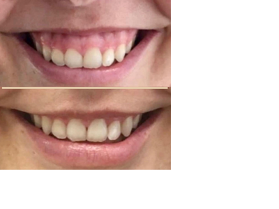 botox trapezius slimming, botox for migraines, botox results, botox injection process, botox treatment room