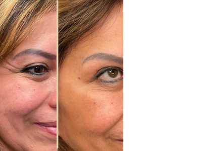 botox crow’s feet, botox brow lift, natural botox results, subtle botox results, botox before and after