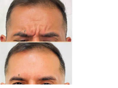 botox forehead, botox 11 lines, glabellar botox, smooth forehead botox, preventative botox