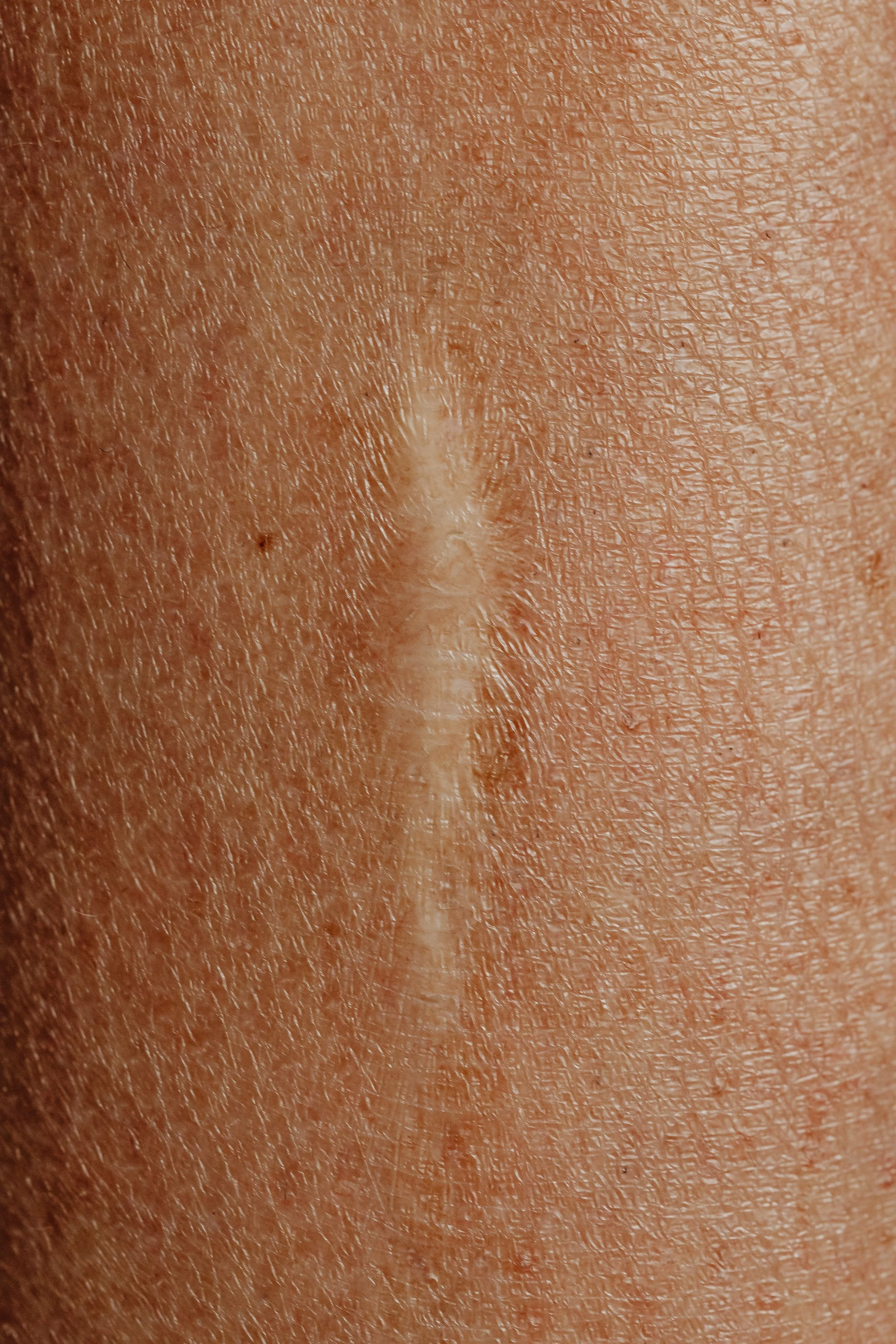 Scar massage sandy utah