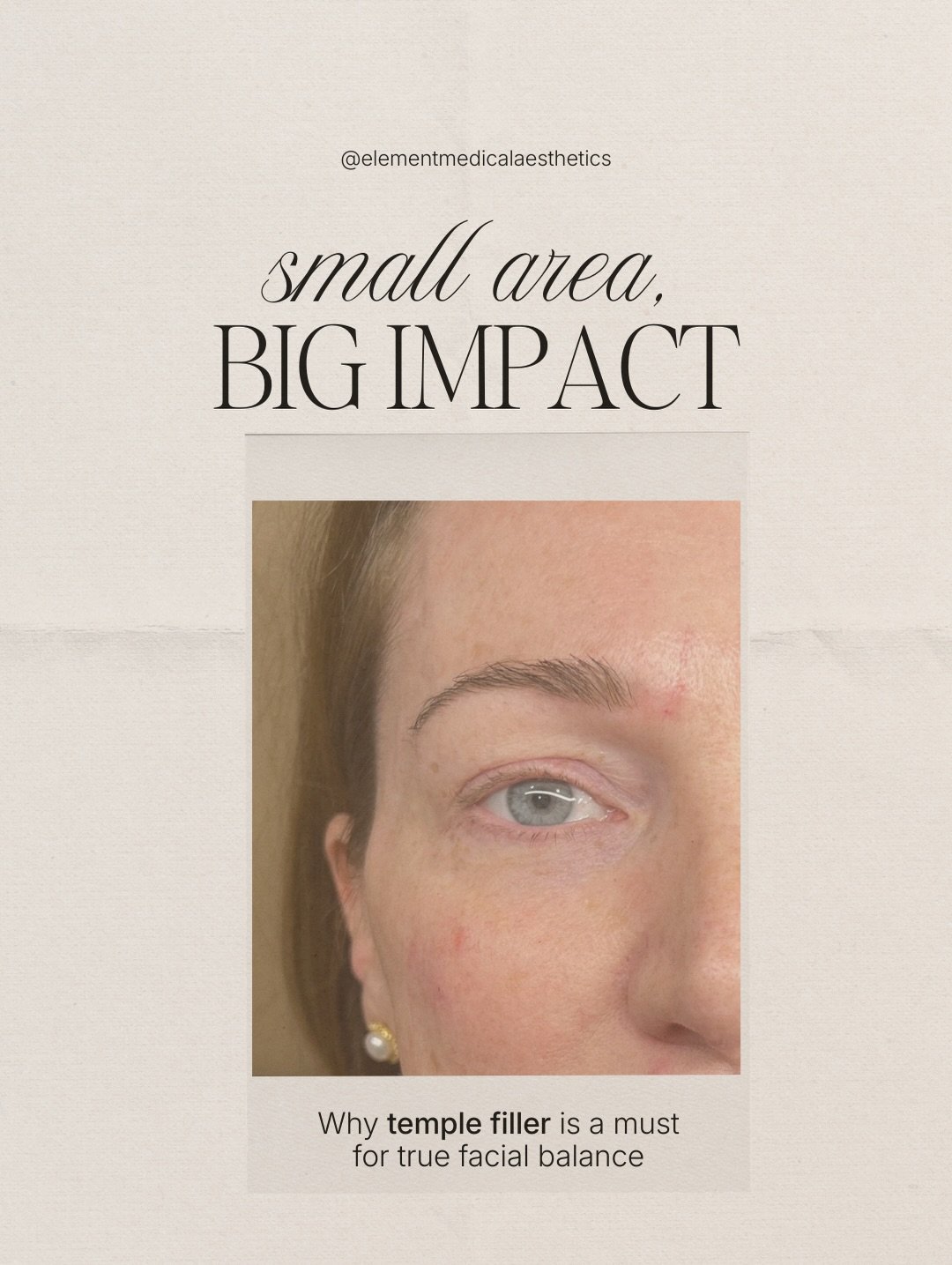 I love treating the temples with a little HA

Yes I love me some Sculptra there too, but approaching the face different ways will create the most natural look 

Temples are a sign of youth and over time, they deplete (especially for my thin patients)