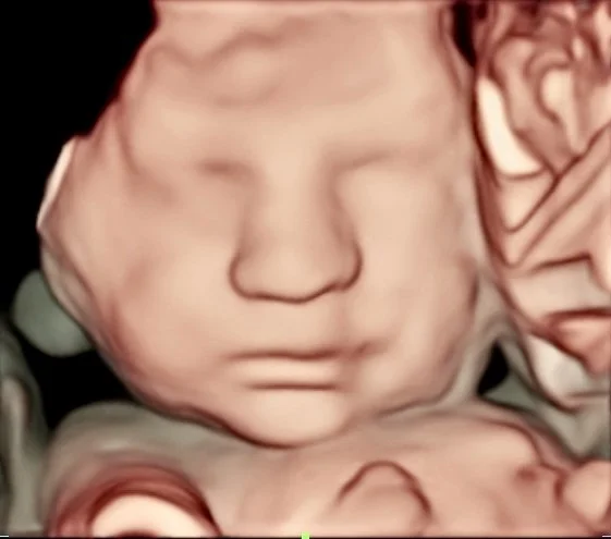 3d ultrasound image in 3rd trimester