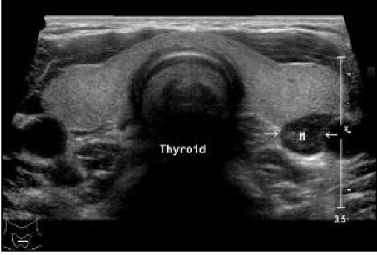 Thyroid