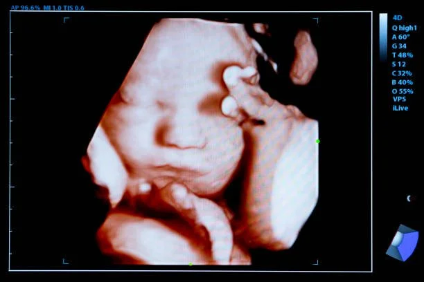 3D/4D Baby Ultrasound