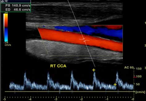 Carotid Doppler