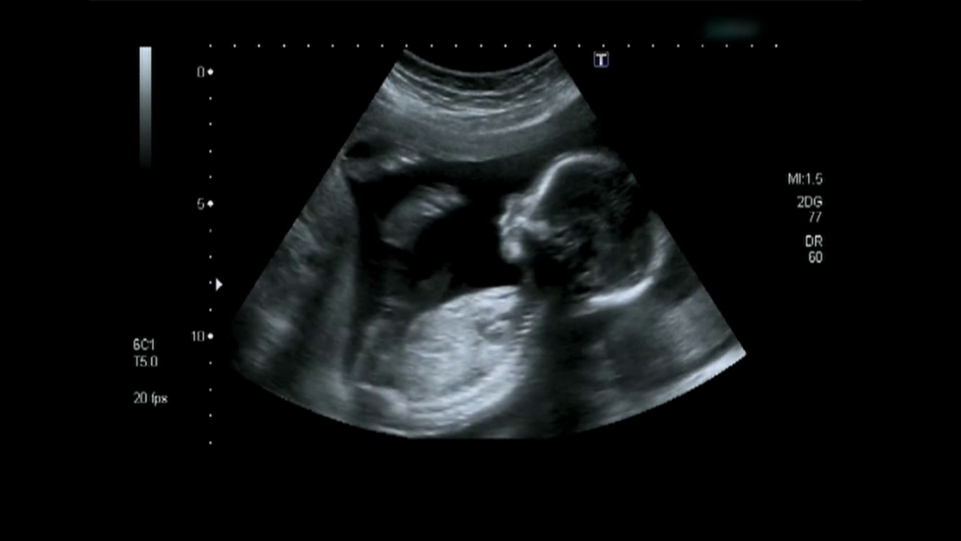2D Baby Ultrasound