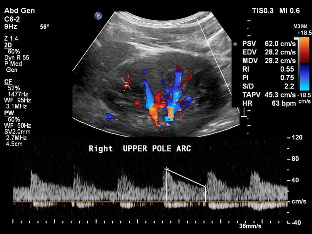 Renal/Kidney Artery Doppler