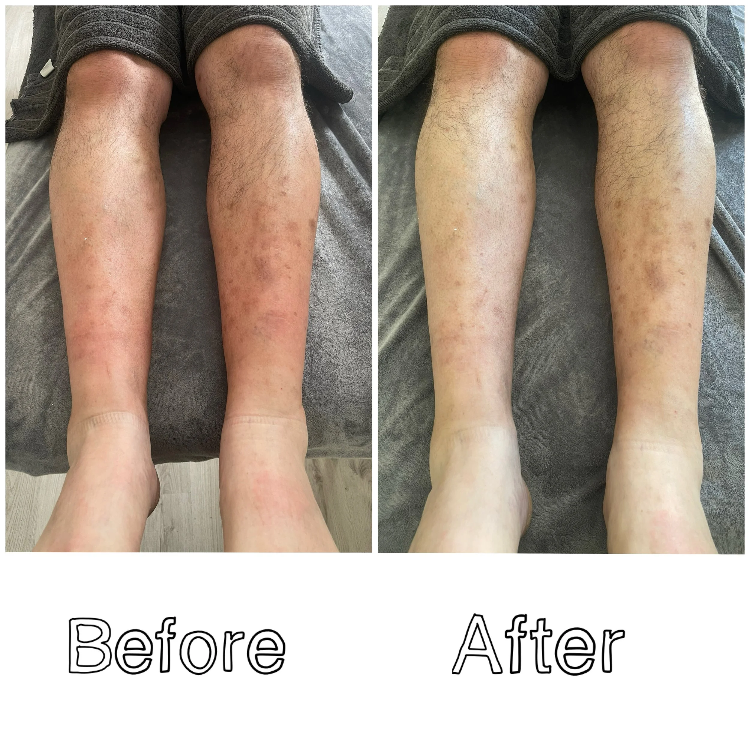 Comparison of person's legs before and after treatment, showing improvement in skin condition.