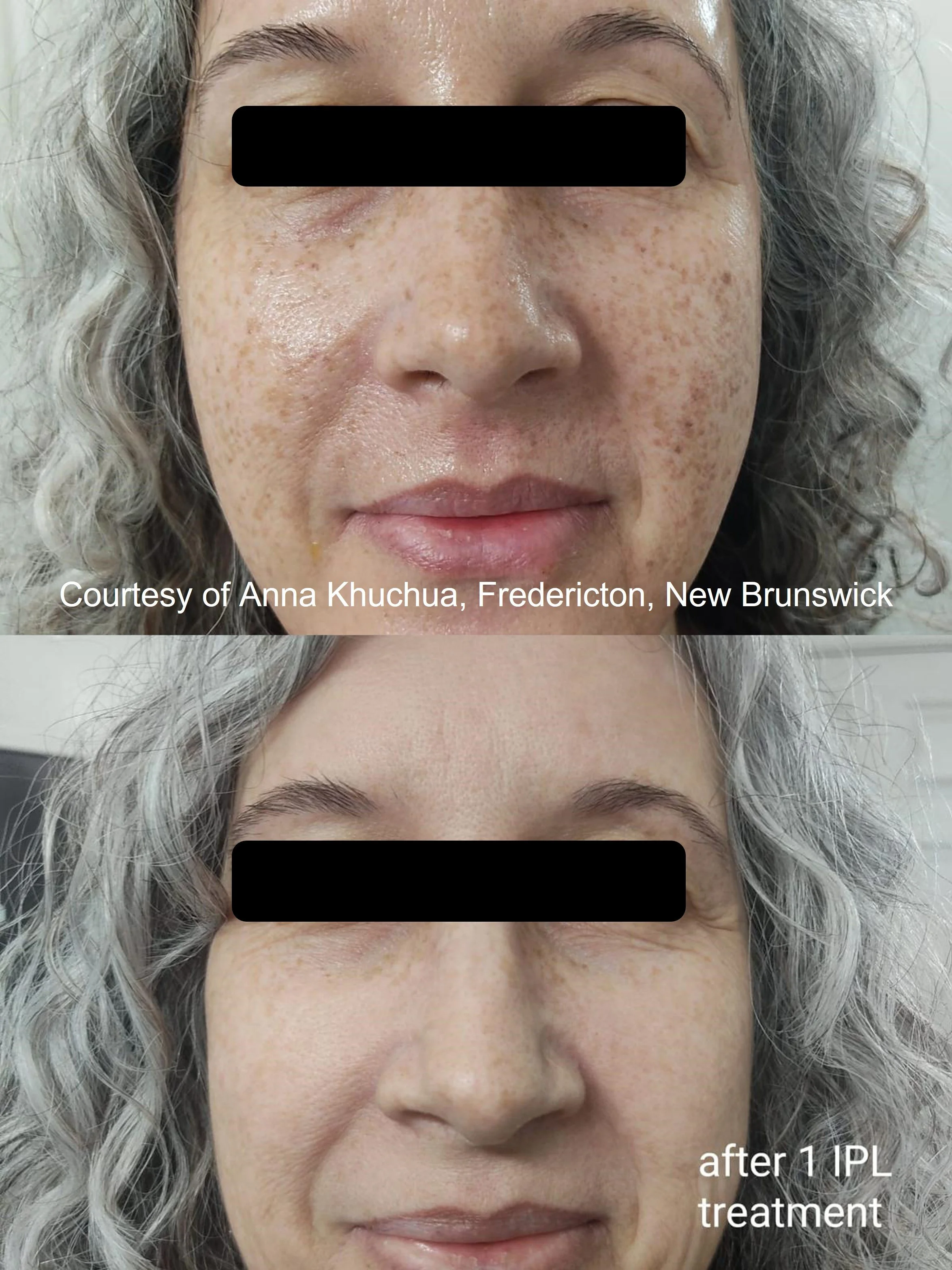 Diffused Pigmentation after 1st treatment.jpg