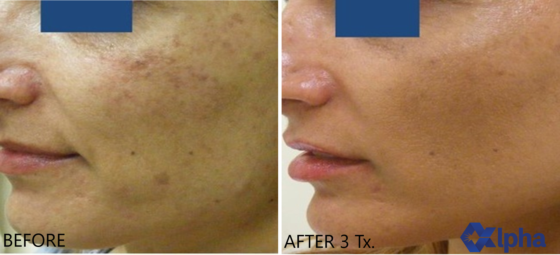 3D IPL B&A_9.png