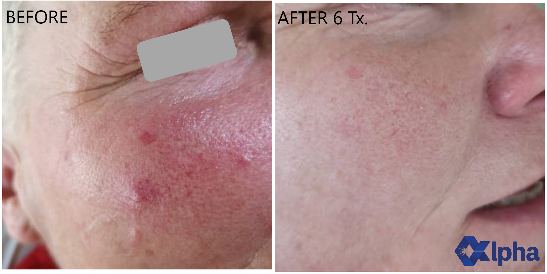 3D IPL B&A_7.png