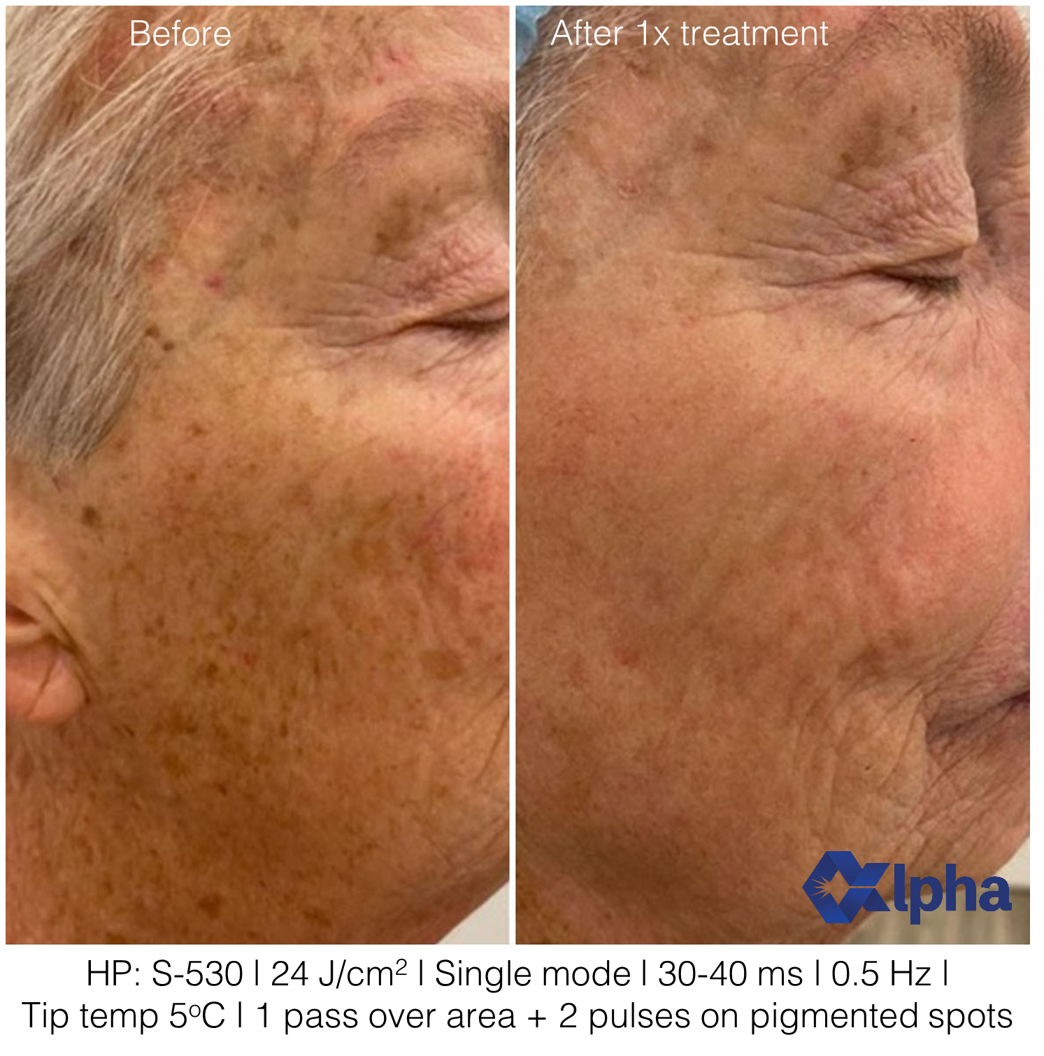 3D IPL B&A_12.png