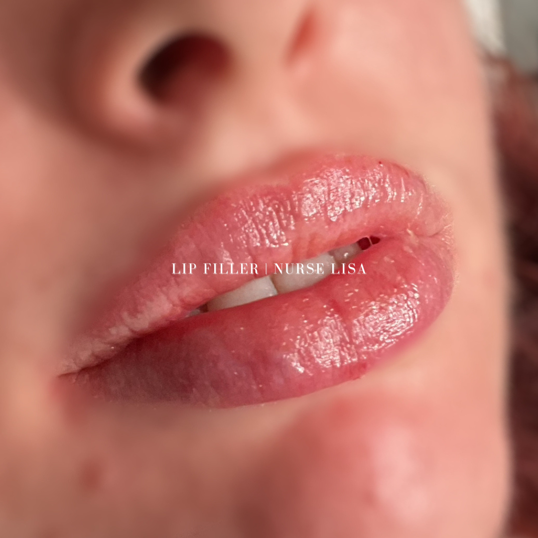 BOTOX FILLERS-56.png